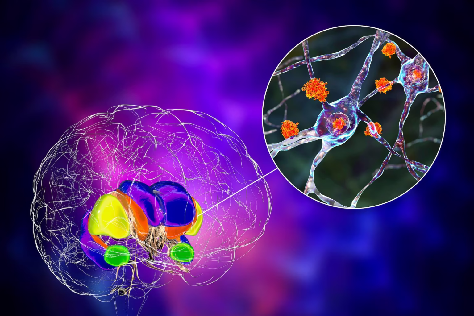 Gene Therapy Slows Huntington’s Disease