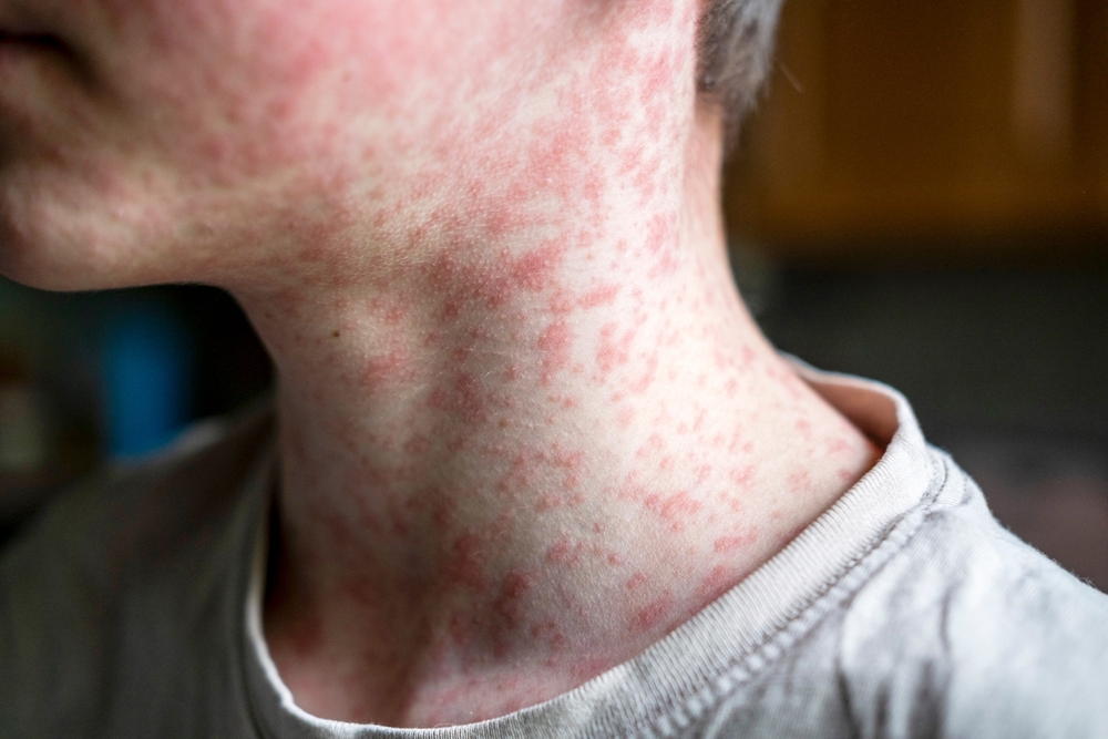 Measles Returns as a Global Threat